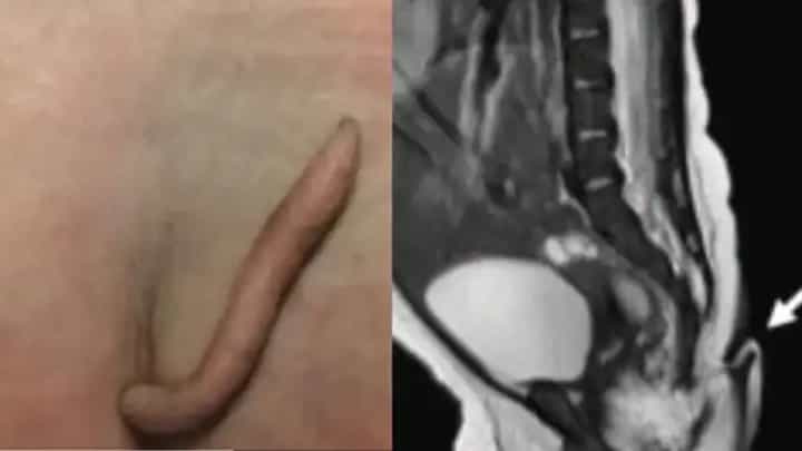 बच्ची की पीठ पर निकली 2 इंच लंबी पूंछ, डॉक्टर भी रह गए दंग! 2 महीने बाद हुई सर्जरी, फिर सामने आई मेडिकल साइंस की हैरान करने वाली कहानी